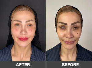 عکسهای قبل و بعد از کانتورینگ با ژل