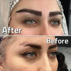 تصاویر کاشت ابرو کلینیک مهرزاد بلافاصله بعد از کاشت