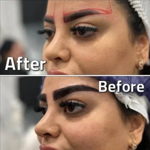تصاویر کاشت ابرو کلینیک مهرزاد بلافاصله بعد از کاشت