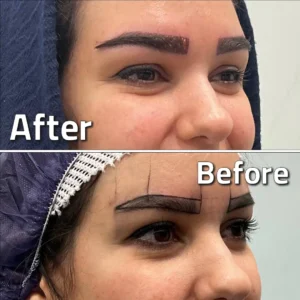 تصاویر کاشت ابرو کلینیک مهرزاد بلافاصله بعد از کاشت