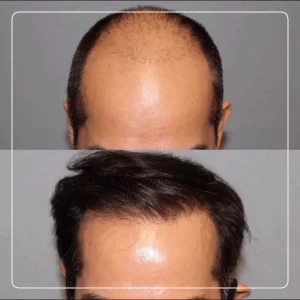 تصاویر کاشت مو کلینیک مهرزاد