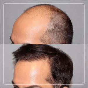 تصاویر کاشت مو کلینیک مهرزاد