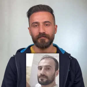 عکس کاشت مو بعد از 4 ماه