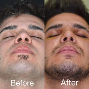 تصاویر رینوپلاستی بلافاصله بعد از عمل