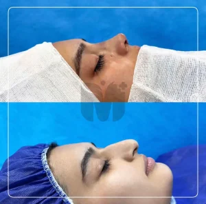 تصاویر رینوپلاستی بلافاصله بعد از عمل