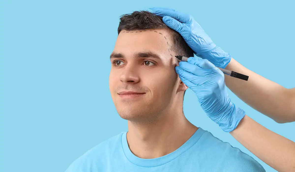 hair-transplant-in-young-people