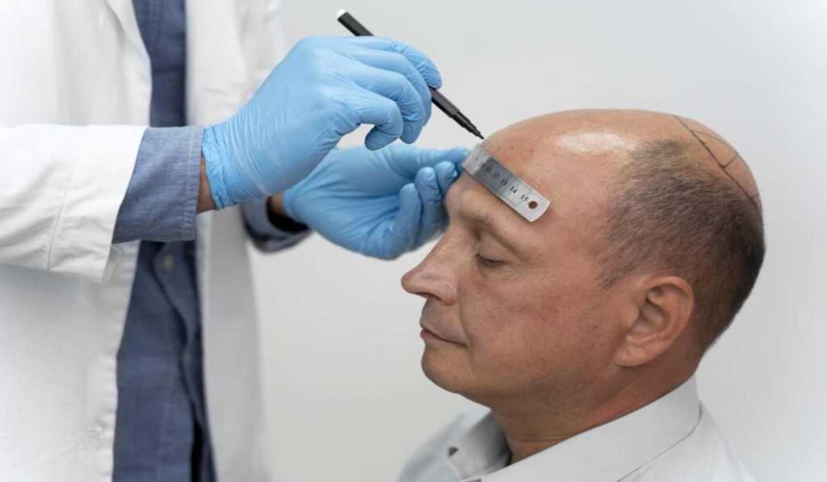کاشت مو یا روش‌های جایگزین : پروتز مو یا ماینوکسیدیل کدام روش بهتر است؟