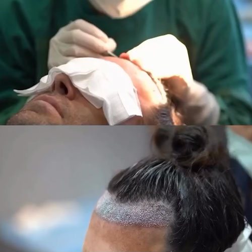 ویدیو کاشت مو کلینیک مهرزاد