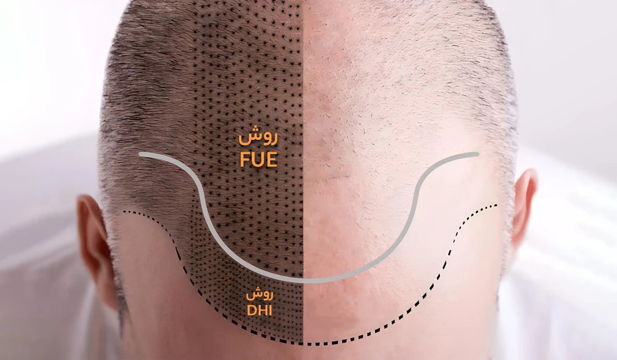 بهترین روش کاشت مو با تراکم بالا و ماندگاری دائمی : FUE + DHI