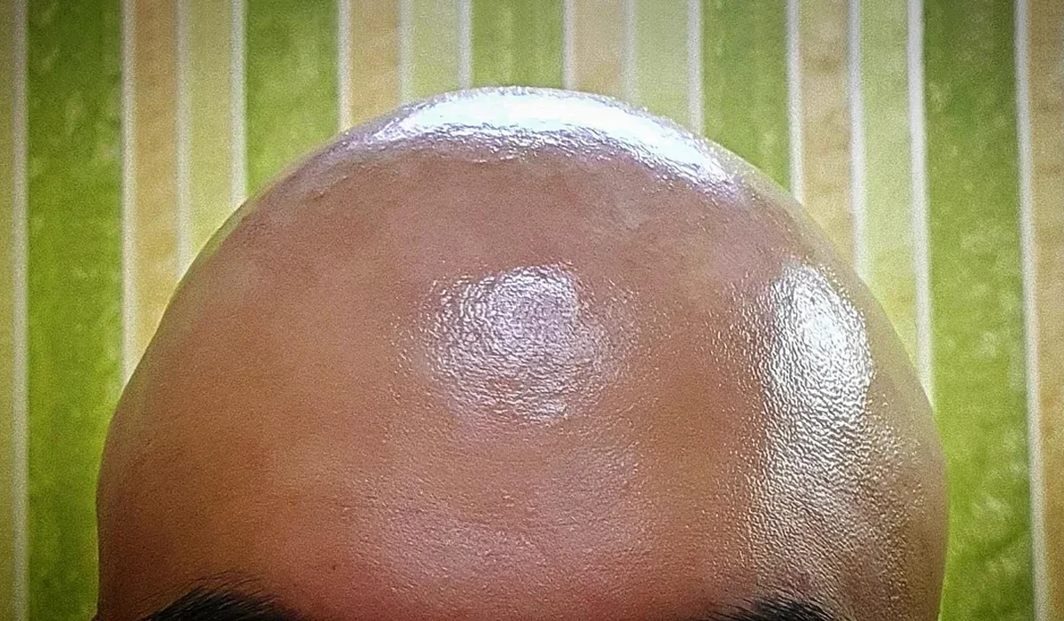 چربی سر بعد از کاشت مو : چقدر رایج است؟ چگونه رفع می‌شود؟