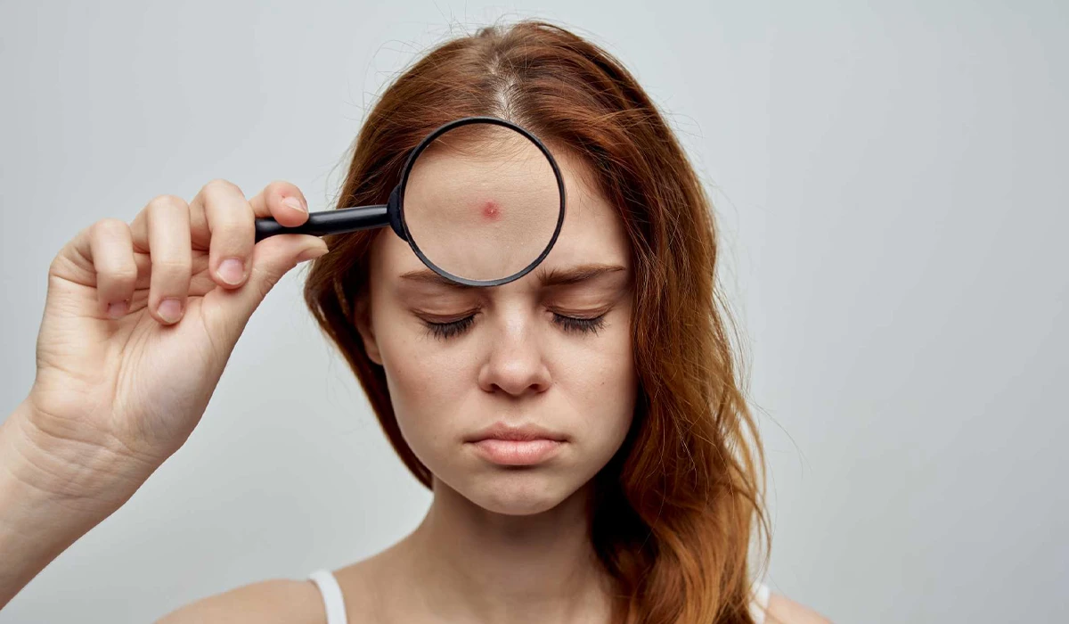 هایفوتراپی برای لک صورت : لک‌های حاصل از پیری ، جوش و ملاسما