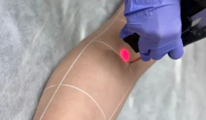 مرکز لیزر افسریه