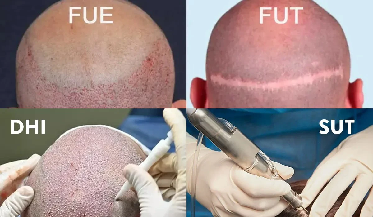 انواع روش انجام کاشت مو