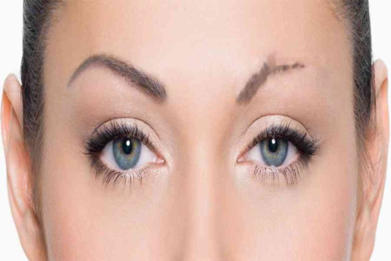 افراد مناسب کاشت ابرو