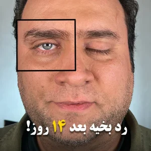 تصاویری از قبل و بعد از عمل بلفاروپلاستی