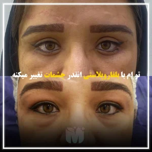 تصاویری از قبل و بعد از عمل بلفاروپلاستی