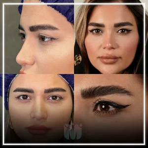 تصاویری از قبل و بعد از عمل بلفاروپلاستی