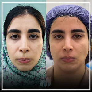 تصاویری از قبل و بعد از عمل بلفاروپلاستی