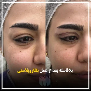 تصاویری از قبل و بعد از عمل بلفاروپلاستی