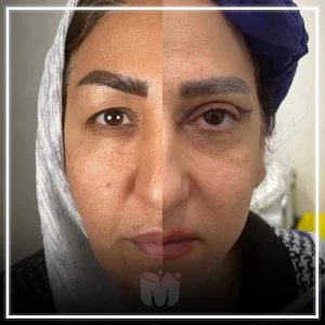 تصاویری از قبل و بعد از عمل بلفاروپلاستی