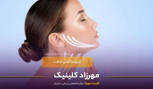 لیپوساکشن غبغب : از مزایا و معایب تا نحوه عمل و نکات ضروری قبل و بعد از درمان