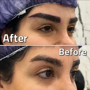 تصاویر کاشت ابرو کلینیک مهرزاد بلافاصله بعد از کاشت