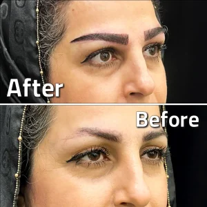تصاویر کاشت ابرو کلینیک مهرزاد بلافاصله بعد از کاشت