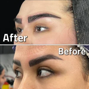 تصاویر کاشت ابرو کلینیک مهرزاد بلافاصله بعد از کاشت
