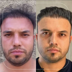 تصاویر کاشت مو کلینیک مهرزاد