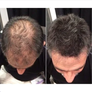 تصاویر کاشت مو کلینیک مهرزاد