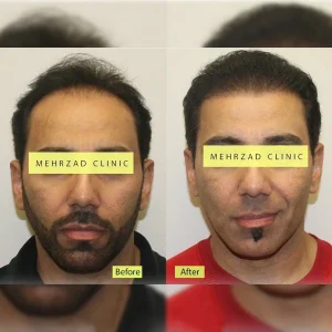تصاویر کاشت مو کلینیک مهرزاد