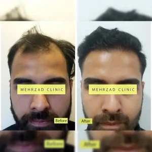 تصاویر کاشت مو کلینیک مهرزاد