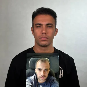 عکس کاشت مو بعد از 4 ماه