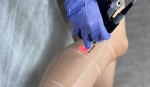 لیزر موهای زائد : برای پوستی صاف و ابریشمی با ماندگاری بالا