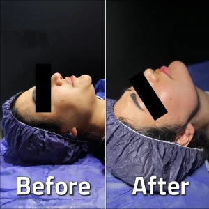 تصاویر لیپوساکشن غبغب بلافاصله بعد از عمل