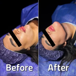 تصاویر لیپوساکشن غبغب بلافاصله بعد از عمل