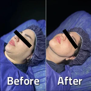 تصاویر لیپوساکشن غبغب بلافاصله بعد از عمل