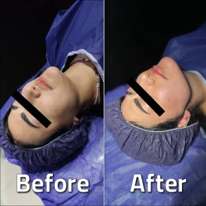 تصاویر لیپوساکشن غبغب بلافاصله بعد از عمل