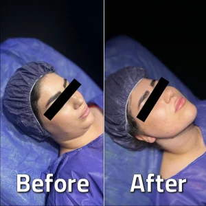 تصاویر لیپوساکشن غبغب بلافاصله بعد از عمل