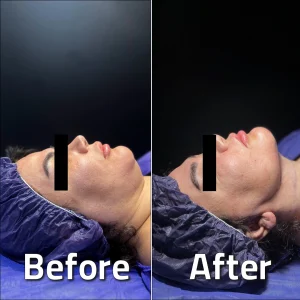 تصاویر لیپوساکشن غبغب بلافاصله بعد از عمل