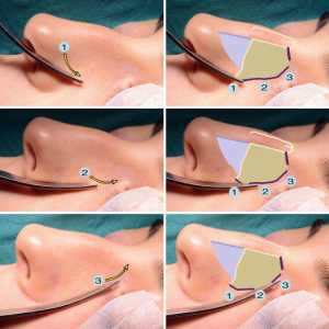 مراحل رینوپلاستی