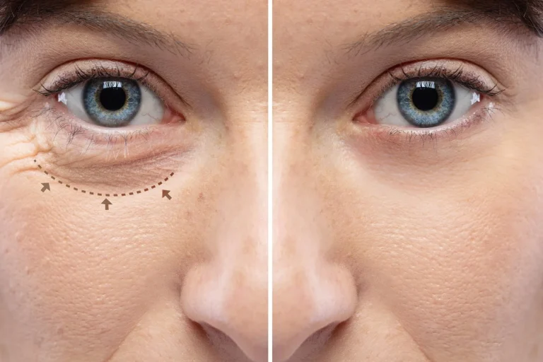 مزایا و معایب بلفاروپلاستی