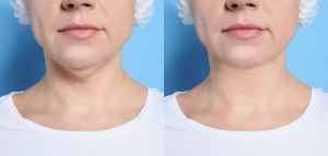 دوران نقاهت بعد از لیپوفیس