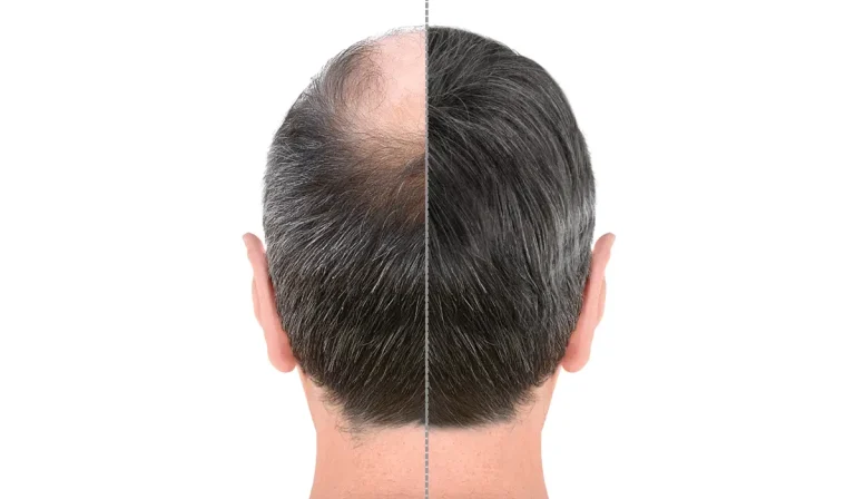 هدف از کاشت مو چیست و چگونه تاثیر خود را نشان می‌دهد؟