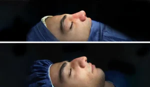 رینوپلاستی یا جراحی بینی : روشی دائمی برای کوچک کردن بینی + تصاویر