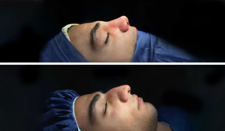 رینوپلاستی یا جراحی بینی : روشی دائمی برای کوچک کردن بینی + تصاویر