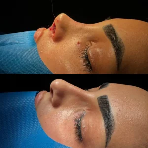 تصاویر رینوپلاستی بلافاصله بعد از عمل