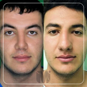 تصاویر رینوپلاستی بلافاصله بعد از عمل