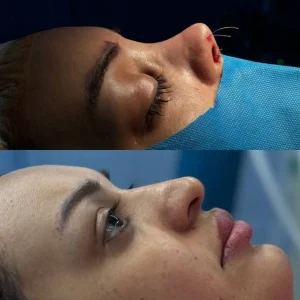 تصاویر رینوپلاستی بلافاصله بعد از عمل