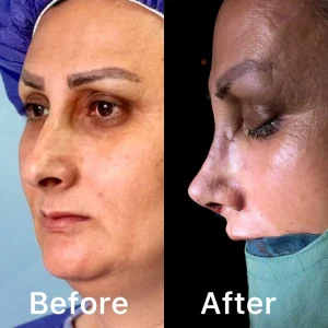 تصاویر رینوپلاستی بلافاصله بعد از عمل